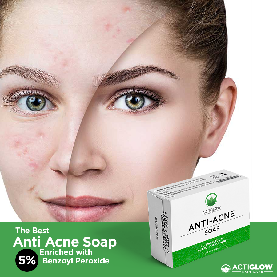 Anti Acne Soap - Pack of 3